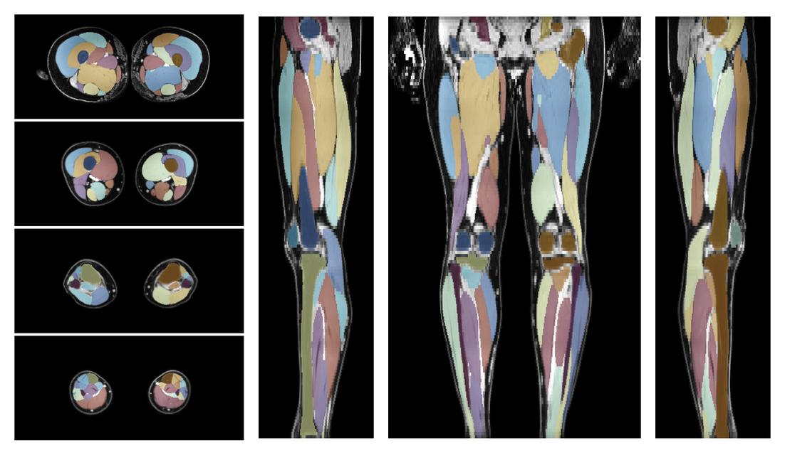 Overlay of automated muscle segmentation labels on dixon water image.